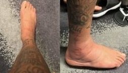 Neymar compartilha foto de tornozelo inchado após lesão (Reprodução/Instagram)